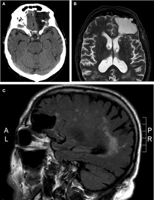 Pulsatile Proptosis due to Intraorbital Meningocele